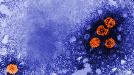 Hepatitis-B-Viruspartikel orange angefärbt; elektronenmikroskopische Aufnahme
