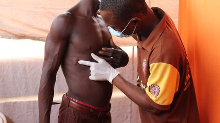 Ein Arzt in Ghana untersucht unter der Haut seitlich am Brustkorb liegende Wurmknoten bei einem Patienten. Der etwa Zweifinger-breite Wurmknoten zeichnet sich unter der Haut ab.