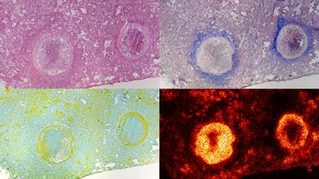 Four single images of differently stained tissue sections with  enclosed tuberculosis granuloma showing different structural elements and accumulated BTZ-043.