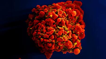  A digitally colourised scanning electron microscopic (SEM) image depicting a single, red-coloured T cell infected by numerous, spheroid shaped, mustard-coloured HIV particles, which can be seen attached to the cell's surface membrane.