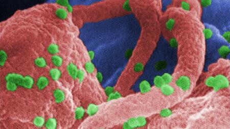 Rasterelektronenmikroskopische Aufnahme von HIV-1 auf Lymphozyten