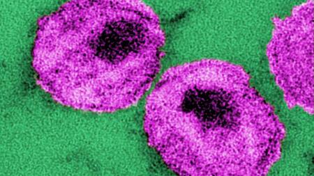 HIV-Viruspartikel im Elektronenmikroskop