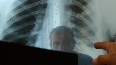 Chest x-rays of the lung are importanft for diagnosis
