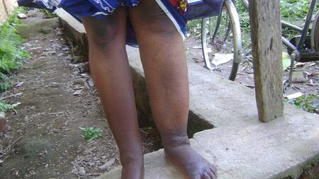 Junge Frau aus dem Studiengebiet in Tansania mit Lymphödem des linken Beines, einer typischen Folge der Filarien-Infektion