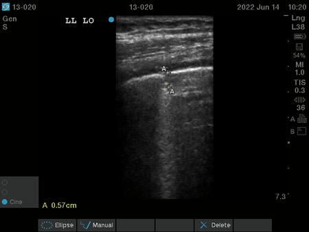 Ultraschallbild der Brust eines Lungentuberkulose-Patienten. Zu sehen sind hellere und dunklere Bereiche, die unter anderem Läsionen und andere Gewebeveränderungen anzeigen.