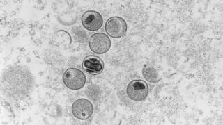 EM Aufnahme in grau von kugeligen Affenpockenviren. Die Virenpartikel sind von abgegrenzten Hüllen umgeben. Im Inneren einiger Partikel sind weitere dunklere Strukturen erkennbar. 