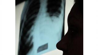 Profile of a man inspecting a lung X-ray image