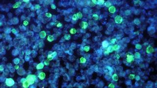 Das Epstein-Barr-Virus, hier in den Zellen grün angefärbt, kann Krebs auslösen