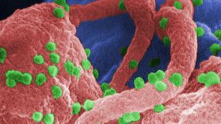 Scanning electron microscope image of HIV-1 on lymphocytes