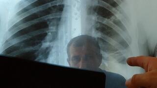 Bessere Heilungschanchen für Patienten mit schwerer Tuberkulose