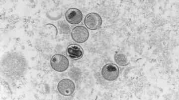 EM Aufnahme in grau von kugeligen Affenpockenviren. Die Virenpartikel sind von abgegrenzten Hüllen umgeben. Im Inneren einiger Partikel sind weitere dunklere Strukturen erkennbar. 