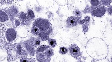 Transmissionselektronenmikroskopisches Bild kugelförmiger Cytomegalovirus-Virionen in Gewebekultur. Die Virionen sind digital blau eingefärbt.