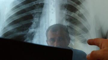 Die Röntgenaufnahme einer Lunge hilft bei der Diagnose