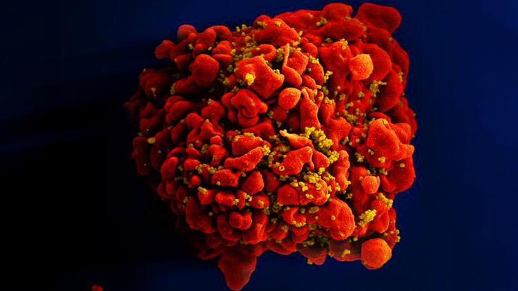 A scanning electron microscope image showing a single red-stained T cell infected by numerous mustard-colored HIV particles adhering to its surface.